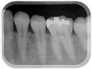 【例】DiagnoCam（KaVo社）による診断プロセスの実例・通常のレントゲン写真