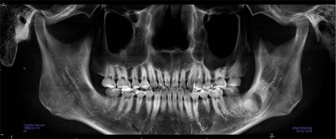 【例1】埋伏歯と下顎神経の関係・パノラマレントゲン