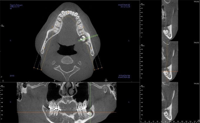 【例1】埋伏歯と下顎神経の関係・CTスキャンで得られらた画像