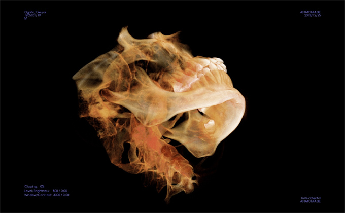 【例1】埋伏歯と下顎神経の関係・3Dシミュレーションによる3DCG画像