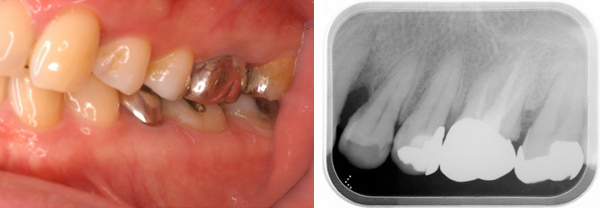【例2】歯周病骨欠損の3次元的状態 ・口腔写真とデジタルレントゲン画像