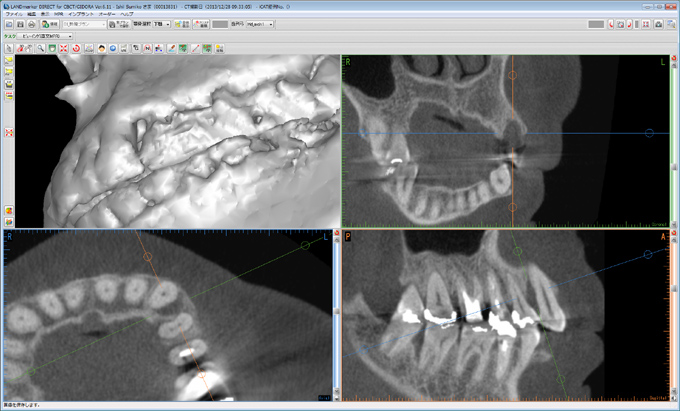 【例2】歯周病骨欠損の3次元的状態・CTで得られた画像