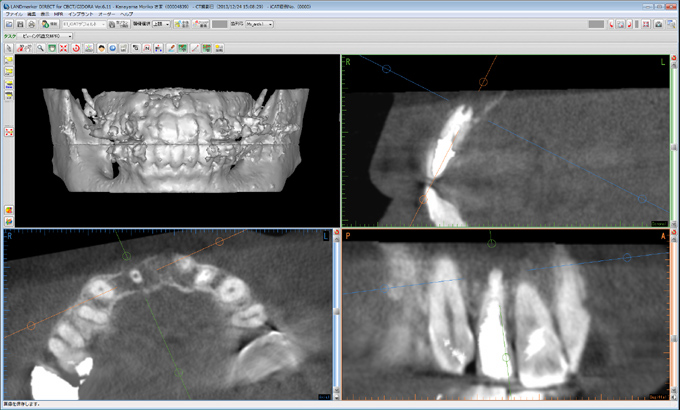 【例3】根尖病変の広がり・CT撮影で得られた画像