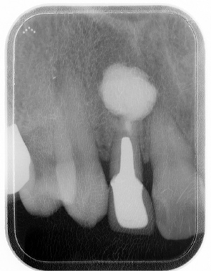 【例3】根尖病変の広がり・術後のレントゲン画像