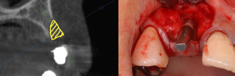 CT撮影により、インプラント部位の骨は大きく陥凹しており、実際、植立するとネジ山が露出します