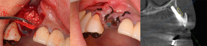 CT撮影により、インプラント部位の骨は大きく陥凹しており、実際、植立するとネジ山が露出します