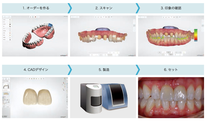 【図3】デジタル印象による補綴物製作の流れ