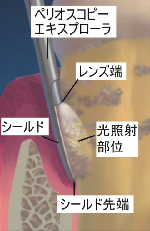 内視鏡のイメージ図