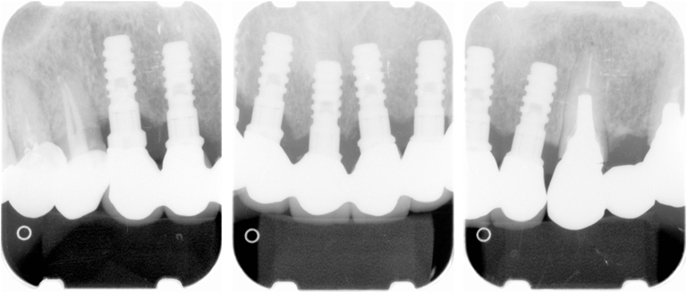 インプラント治療のレントゲン写真