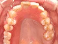 バルプラスト・薄くできるので違和感が軽減されます