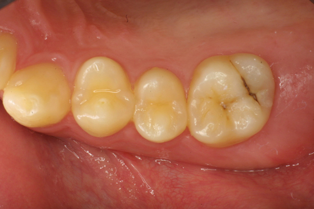 【1】奥歯の溝に出来たむし歯